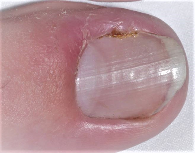 Treatment for Ingrown Toenail